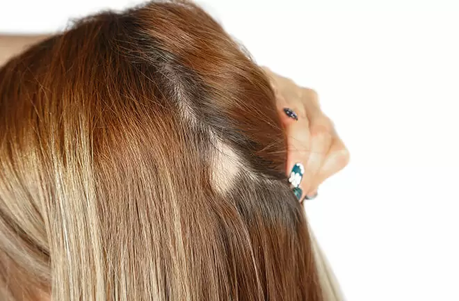 6 principais motivos para queda de cabelo e como solucioná-los